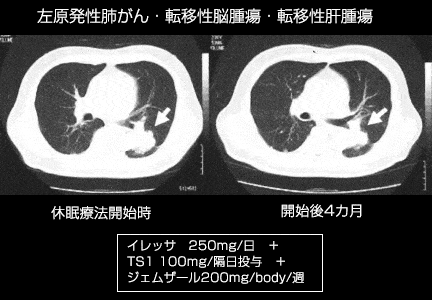 左：原発性肺がん・転移性脳腫瘍・転移性肝腫瘍