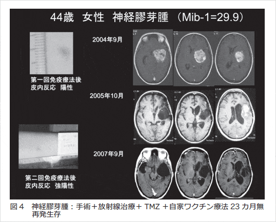 神経膠芽腫：手術+放射線治療+TMZ+自家がんワクチン療法23ヶ月無再発生存